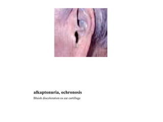 alkaptonuria, ochronosis Bluish discoloration os ear cartillage 
