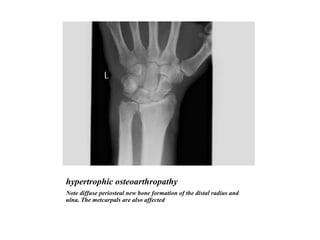 hypertrophic osteoarthropathy Note diffuse periosteal new bone formation of the distal radius and ulna. The metcarpals are also affected 