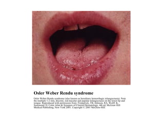 Osler Weber Rendu syndrome Osler Weber Rendu syndrome (also known as hereditary hemorrhagic telangiectasia). Note the multiple 1-2 mm, discrete, red macular and papular telangiectases on the lower lip and tongue. Reproduced with permission from: Fitzpatrick, TB, Johnson, RA, Wolff, K, Suurmond, D. Color Atlas & Synopsis of Clinical Dermatology, 4th ed, McGraw Hill Medical Publishing, New York 2001. Copyright © 2001 McGraw-Hill. 