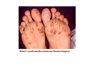 Reiter's syndrome(Keratoderma blennorrhagica) 