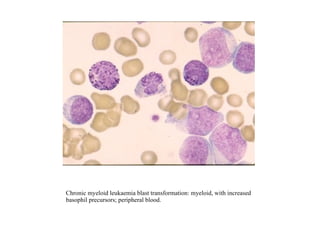 Chronic myeloid leukaemia blast transformation: myeloid, with increased basophil precursors; peripheral blood. 