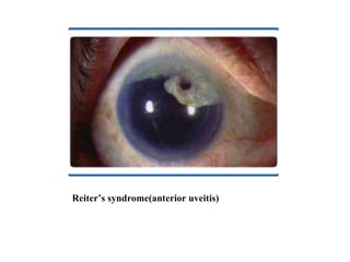 Reiter’s syndrome(anterior uveitis) 