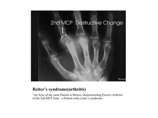 Reiter’s syndrome(arthritis) "An Xray of the same Patient is Shown, Demonstrating Erosive Arthritis of the 2nd MCP Joint : a Patient with a reite’s syndrome 