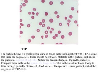 TTP The picture below is a microscopic view of blood cells from a patient with TTP. Notice that there are no platelets. There should be 10 to 20 platelets in this picture, just like in the picture of  normal blood cells . Notice the broken shapes of the red blood cells. Compare these cells to the  normal red blood cells . This is the result of blood trying to flow through partially obstructed blood vessels. This picture is an important part of the diagnosis of TTP-HUS . 