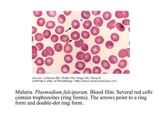 Malaria, falciparum Malaria.  Plasmodium falciparum.  Blood film. Several red cells contain trophozoites (ring forms). The arrows point to a ring form and double-dot ring form. 