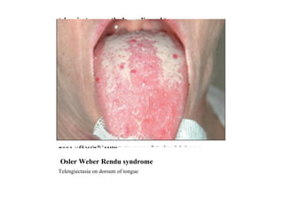 telangiectases on the lower lip and tongue. Reproduced with permission from: Fitzpatrick, TB, Johnson, RA, Wolff, K, Suurmond, D. Color Atlas & Synopsis of Clinical Dermatology, 4th ed, McGraw Hill Medical Publishing, New York 2001. Copyright © 2001 McGraw-Hill. Osler Weber Rendu syndrome Osler Weber Rendu syndrome (also known as hereditary hemorrhagic telangiectasia). Note the multiple 1-2 mm, discrete, red macular and papular telangiectases on the lower lip and tongue. Reproduced with permission from: Fitzpatrick, TB, Johnson, RA, Wolff, K, Suurmond, D. Color Atlas & Synopsis of Clinical Dermatology, 4th ed, McGraw Hill Medical Publishing, New York 2001. Copyright © 2001 McGraw-Hill.  Osler Weber Rendu syndrome Telengiectasia on dorsum of tongue 