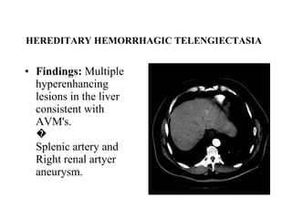 HEREDITARY HEMORRHAGIC TELENGIECTASIA   Findings:  Multiple hyperenhancing lesions in the liver consistent with AVM's. �  Splenic artery and Right renal artyer aneurysm. 