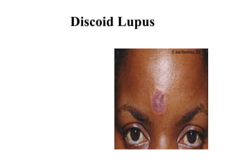Discoid Lupus 