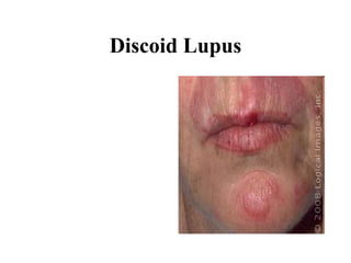 Discoid Lupus 