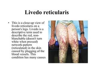 Livedo reticularis  This is a close-up view of livedo reticularis on a person's legs. Livedo is a descriptive term used to describe the red, non-blanchable (doesn't turn white when pressed) network-pattern (reticulated) in the skin caused by plugging of the blood vessels. This condition has many causes  