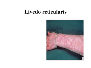 Livedo reticularis 