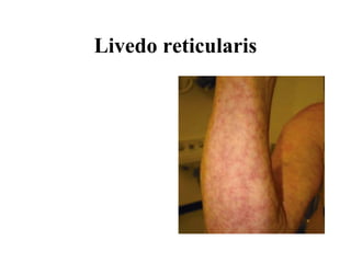 Livedo reticularis 