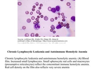 Chronic Lymphocytic Leukemia and Autoimmune Hemolytic Anemia Chronic lymphocytic leukemia and autoimmune hemolytic anemia. ( A ) Blood film. Increased small lymphocytes. Small spherocytic red cells and macrocytes (presumptive reticulocytes) reflect the concomitant immune hemolytic anemia. Red cell density on the film also reflects very severe anemia 