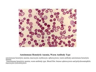 Autoimmune Hemolytic Anemia, Warm Antibody Type autoimmune hemolytic anemia; macrocytic erythrocyte; spherocytosis; warm antibody autoimmune hemolytic anemia.    Autoimmune hemolytic anemia, warm antibody type. Blood film. Intense spherocytosis and polychromatophilic macrocytes (reticulocytosis ).  