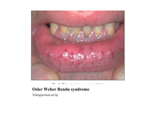 Osler Weber Rendu syndrome Telengiectasia on lip 