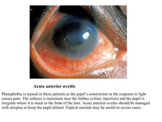 Acute anterior uveitis Photophobia is typical in these patients as the pupil’s constriction in the response to light causes pain. The redness is maximum near the limbus (ciliary injection) and the pupil is irregular where it is stuck to the front of the lens. Acute anterior uveitis should be managed with atropine to keep the pupil dilated. Topical steroids may be useful in severe cases. 