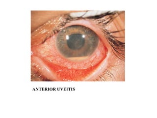 ANTERIOR UVEITIS 