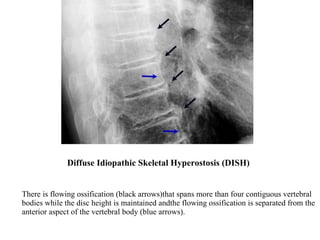 Diffuse Idiopathic Skeletal Hyperostosis (DISH) There is flowing ossification (black arrows)that spans more than four contiguous vertebral bodies while the disc height is maintained andthe flowing ossification is separated from the anterior aspect of the vertebral body (blue arrows). 