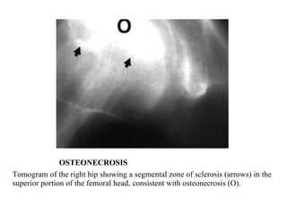OSTEONECROSIS Tomogram of the right hip showing a segmental zone of sclerosis (arrows) in the superior portion of the femoral head, consistent with osteonecrosis (O). 