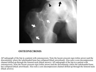 OSTEONECROSIS AP radiograph of the hip in a patient with osteonecrosis. Note the lucent crescent sign (white arrow) and the discontinuity where the subchondral bone has collapsed (black arrowhead). Also note a core decompression channel drilled up through the femoral neck (black arrows). AP radiograph of the hip in a patient with osteonecrosis. Note the lucent crescent sign (white arrow) and the discontinuity where the subchondral bone has collapsed (black arrowhead). Also note a core decompression channel drilled up through the femoral neck (black arrows). 