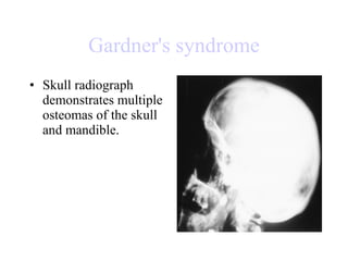 Gardner's syndrome Skull radiograph demonstrates multiple osteomas of the skull and mandible.  
