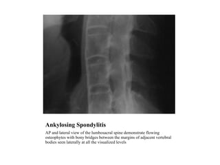Ankylosing Spondylitis AP and lateral view of the lumbosacral spine demonstrate flowing osteophytes with bony bridges between the margins of adjacent vertebral bodies seen laterally at all the visualized levels 