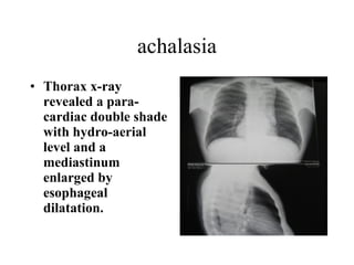 achalasia Thorax x-ray revealed a para-cardiac double shade with hydro-aerial level and a mediastinum enlarged by esophageal dilatation.   