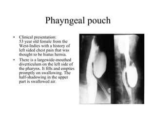 Phayngeal pouch Clinical presentation: 53 year old female from the West-Indies with a history of left sided chest pain that was thought to be hiatus hernia.  There is a largewide-mouthed diverticulum on the left side of the pharynx. It fills and empties promptly on swallowing. The half-shadowing in the upper part is swallowed air.  