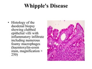 Whipple's Disease Histology of the duodenal biopsy showing clubbed epithelial villi with inflammatory infiltrate including numerous foamy macrophages (haemtoxylin-eosin stain, magnification × 250)  