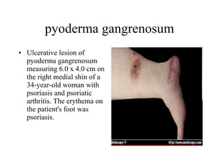 pyoderma gangrenosum Ulcerative lesion of pyoderma gangrenosum measuring 6.0 x 4.0 cm on the right medial shin of a 34-year-old woman with psoriasis and psoriatic arthritis. The erythema on the patient's foot was psoriasis.  