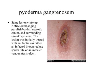pyoderma gangrenosum Same lesion close up. Notice overhanging purplish border, necrotic center, and surrounding rim of erythema. This lesion was initially treated with antibiotics as either an infected brown recluse spider bite or an infected venous stasis ulcer.  