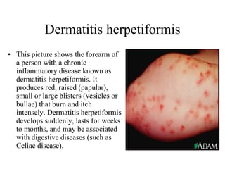 Dermatitis herpetiformis This picture shows the forearm of a person with a chronic inflammatory disease known as dermatitis herpetiformis. It produces red, raised (papular), small or large blisters (vesicles or bullae) that burn and itch intensely. Dermatitis herpetiformis develops suddenly, lasts for weeks to months, and may be associated with digestive diseases (such as Celiac disease).  