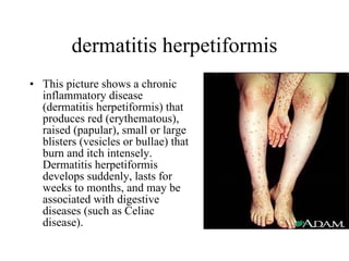 dermatitis herpetiformis This picture shows a chronic inflammatory disease (dermatitis herpetiformis) that produces red (erythematous), raised (papular), small or large blisters (vesicles or bullae) that burn and itch intensely. Dermatitis herpetiformis develops suddenly, lasts for weeks to months, and may be associated with digestive diseases (such as Celiac disease).  