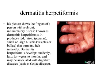 dermatitis herpetiformis his picture shows the fingers of a person with a chronic inflammatory disease known as dermatitis herpetiformis. It produces red, raised (papular), small or large blisters (vesicles or bullae) that burn and itch intensely. Dermatitis herpetiformis develops suddenly, lasts for weeks to months, and may be associated with digestive diseases (such as Celiac disease).  