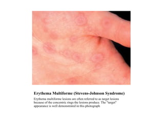 Erythema Multiforme (Stevens-Johnson Syndrome) Erythema multiforme lesions are often referred to as target lesions because of the concentric rings the lesions produce. The "target" appearance is well demonstrated in this photograph 