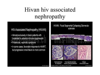 Hivan hiv associated nephropathy 