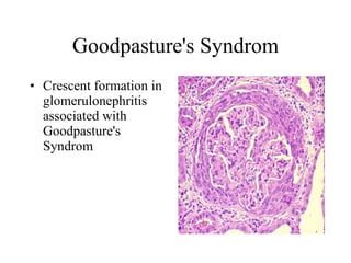 Goodpasture's Syndrom Crescent formation in glomerulonephritis associated with Goodpasture's Syndrom  