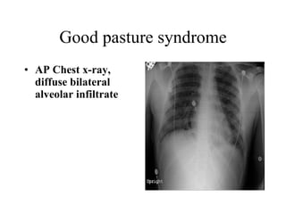 Good pasture syndrome AP Chest x-ray, diffuse bilateral alveolar infiltrate   