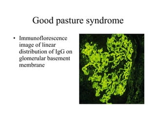 Good pasture syndrome Immunoflorescence image of linear distribution of IgG on glomerular basement membrane  