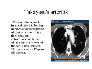 Takayasu's arteritis . Computed tomographic image obtained following intravenous administration of contrast demonstrates thickening and enhancement of the wall of the aorta at the level of the aortic arch (arrows). The patient was a 32-year-old woman.  