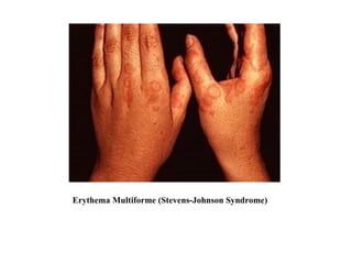 Erythema Multiforme (Stevens-Johnson Syndrome) 