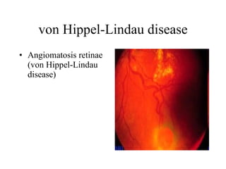 von Hippel-Lindau disease Angiomatosis retinae (von Hippel-Lindau disease)  