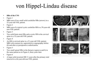 von Hippel-Lindau disease HBs of the CNS Figure 1 MRI scan of two small solid cerebellar HBs (arrows) in a 52-year-old VHL patient. Figure 2  MRI scan of a typical cystic cerebellar HB in a 39-year-old non-VHL patient. Figure 3 Two solid brain stem HBs and a cystic HB in the cervical spine in a 32-year-old VHL patient. Figure 4  An HB in cervical spine in a 21-year-old VHL patient: MRI with contrast (a), superselective angiography before (b) and after (c) preoperative embolization. Figure 5 Two small spinal HBs in the thoracic region (a and b) in the same patient as in Figure 4, three years later. Figure 6 A large solid recurrent HB 11 years after the primary total removal in a 66-year-old non-VHL patient. 