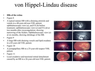 von Hippel-Lindau disease HBs of the retina Figure 8 A typical mature HB with a draining arteriole and venule in a 40-year-old non-VHL patient: ophthalmoscopic view (a), and FA (b) before treatment; ophthalmoscopic view (c) and FA (d) at two months after cryocoagulation, showing narrowing of the feeders. Ophthalmoscopic view (e) at six months, showing shrinkage of the HB. Figure 9 A large HB with draining vessels and lipid exudates in a 65-year-old VHL patient. Figure 10 A juxtapapillary HB in a 25-year-old suspect VHL patient. Figure 11 Local exudative and tractional retinal detachment caused by an HB in a 26-year-old non-VHL patient. 