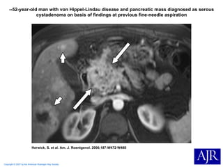 Copyright © 2007 by the American Roentgen Ray Society Herwick, S. et al. Am. J. Roentgenol. 2006;187:W472-W480 --52-year-old man with von Hippel-Lindau disease and pancreatic mass diagnosed as serous cystadenoma on basis of findings at previous fine-needle aspiration 