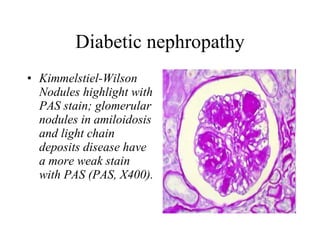 Diabetic nephropathy Kimmelstiel-Wilson Nodules highlight with PAS stain; glomerular nodules in amiloidosis and light chain deposits disease have a more weak stain with PAS (PAS, X400).   