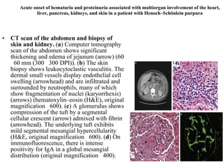 Acute onset of hematuria and proteinuria associated with multiorgan involvement of the heart, liver, pancreas, kidneys, and skin in a patient with Henoch–Schönlein purpura CT scan of the abdomen and biopsy of skin and kidney.  ( a ) Computer tomography scan of the abdomen shows significant thickening and edema of jejunum (arrow) (60  60 mm (300  300 DPI)). ( b ) The skin biopsy shows leukocytoclastic vasculitis. The dermal small vessels display endothelial cell swelling (arrowhead) and are infiltrated and surrounded by neutrophils, many of which show fragmentation of nuclei (karyorrhexis) (arrows) (hematoxylin–eosin (H&E), original magnification  600). ( c ) A glomerulus shows compression of the tuft by a segmental cellular crescent (arrow) admixed with fibrin (arrowhead). The underlying tuft exhibits mild segmental mesangial hypercellularity (H&E, original magnification  600). ( d ) On immunofluorescence, there is intense positivity for IgA in a global mesangial distribution (original magnification  400).  