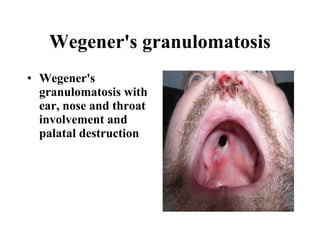 Wegener's granulomatosis Wegener's granulomatosis with ear, nose and throat involvement and palatal destruction 