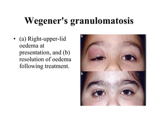 Wegener's granulomatosis (a) Right-upper-lid oedema at presentation, and (b) resolution of oedema following treatment.  