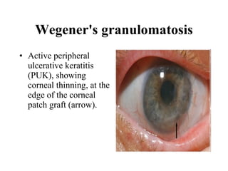Wegener's granulomatosis Active peripheral ulcerative keratitis (PUK), showing corneal thinning, at the edge of the corneal patch graft (arrow).  